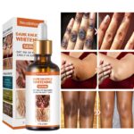 Acanthosis Nigricans Therapy Oil