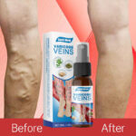 Veins Treatment Spray